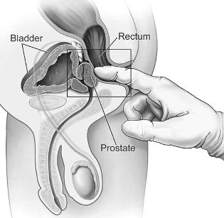 treatment of prostatitis-house massage